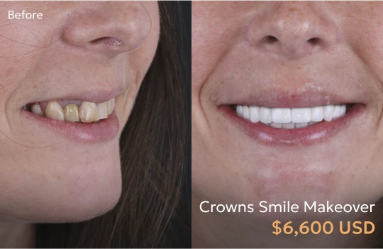Before and after images of dental crowns in Tijuana